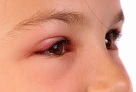 Bacterial Conjunctivitis